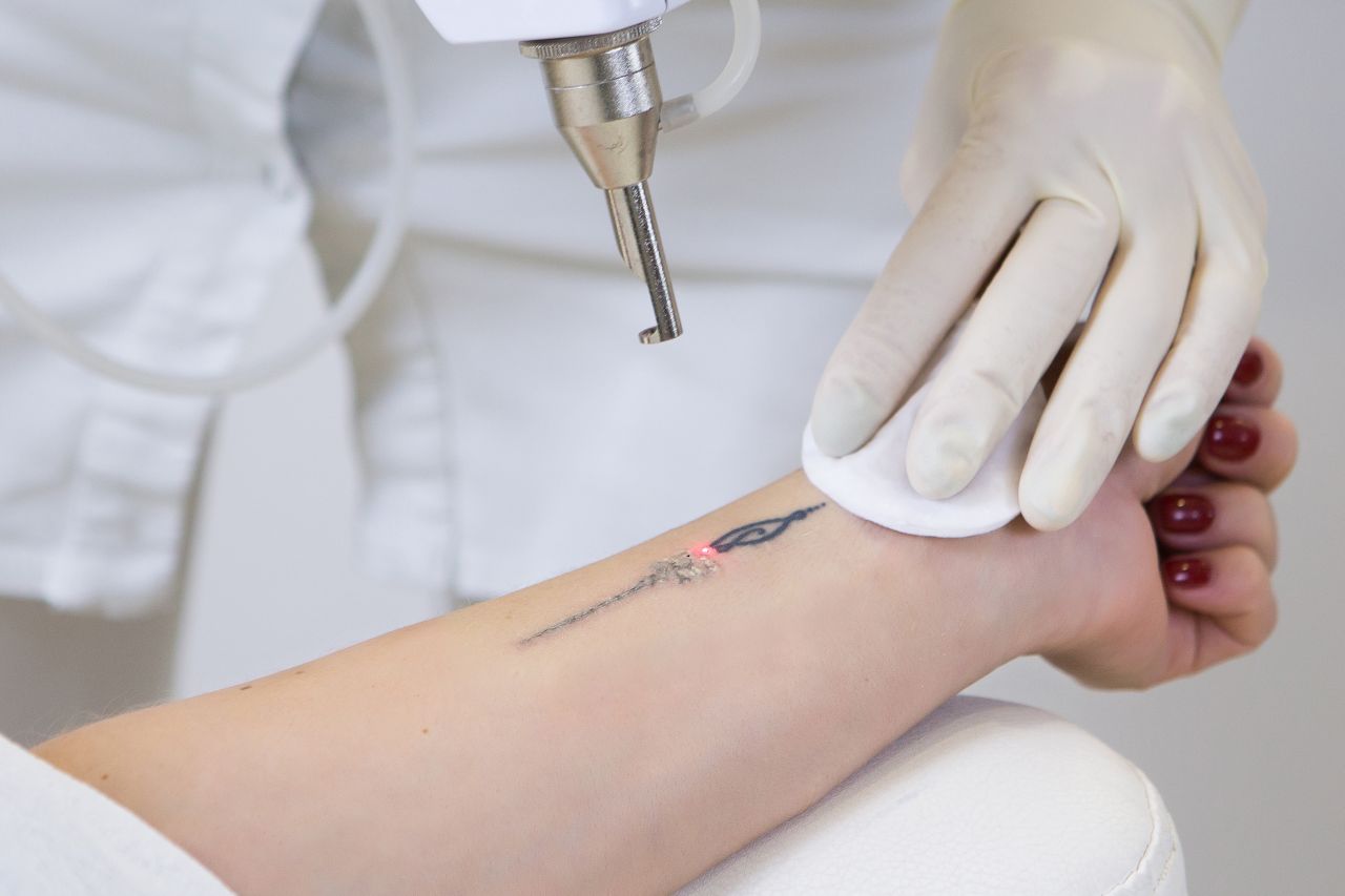 Laserowe usuwanie tatuażu – na czym polega?